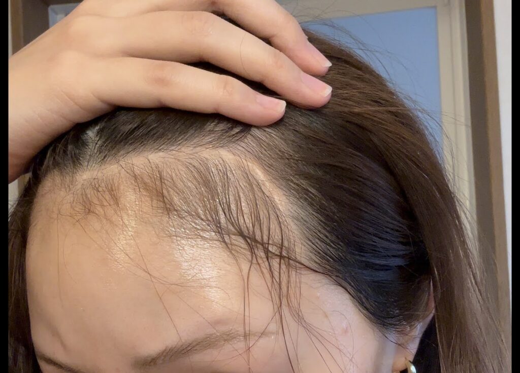 手術から約4年半後の傷跡。