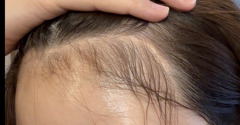 手術から約4年半後の傷跡。