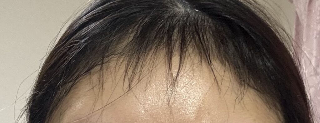 植毛から4ヶ月の写真