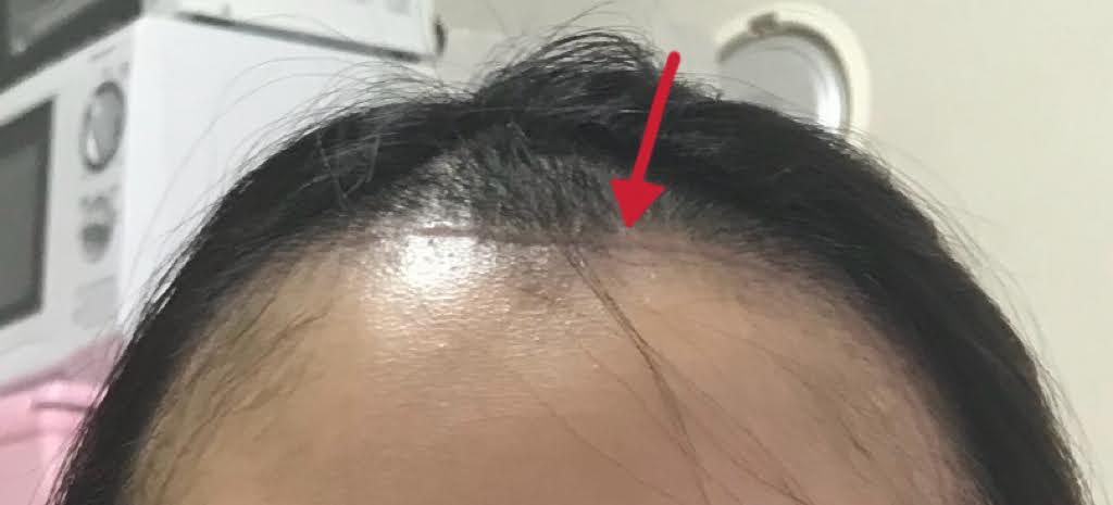 脳出血手術後の傷跡