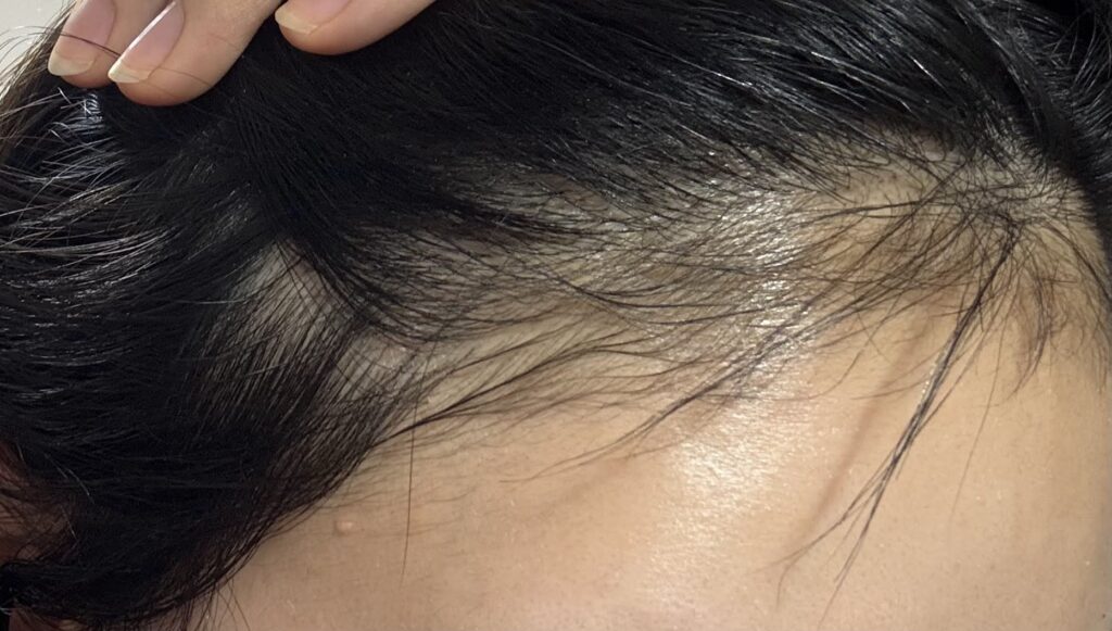 植毛から6ヶ月の写真