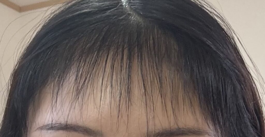 植毛から半年後