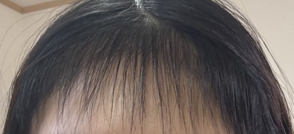 植毛から半年後