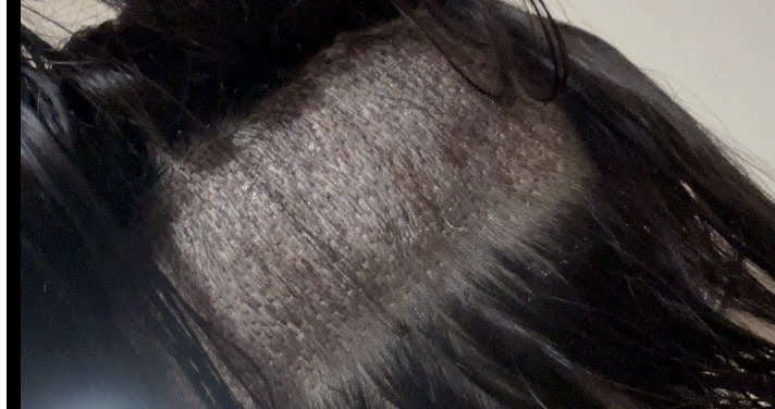 術直後の後頭部