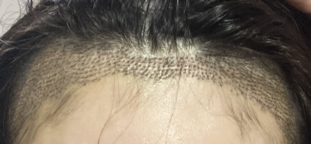 手術から10日後