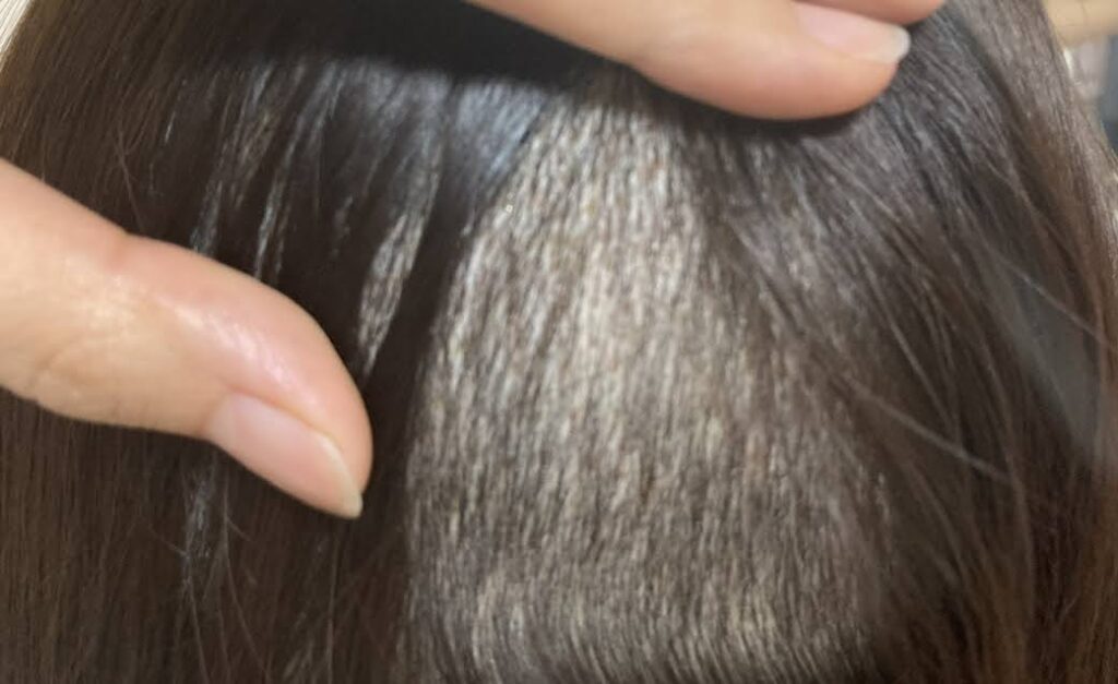 手術から10日後の後頭部