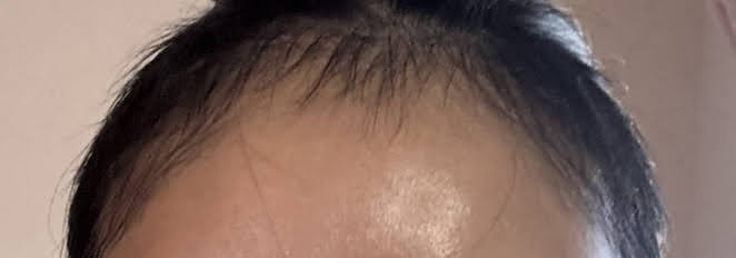 手術から3か月後