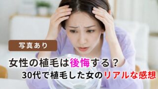 女性のヘアライン植毛は後悔する？韓国で植毛した女の半年後の感想