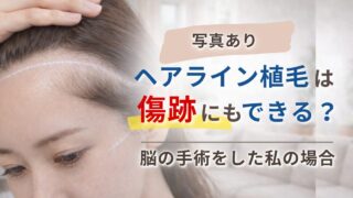 【写真あり】ヘアライン植毛は傷跡にもできる？脳の手術をした私の場合