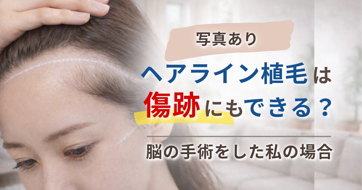 【写真あり】ヘアライン植毛は傷跡にもできる？脳の手術をした私の場合