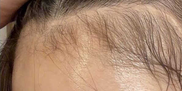 手術から約4年半後の傷跡。