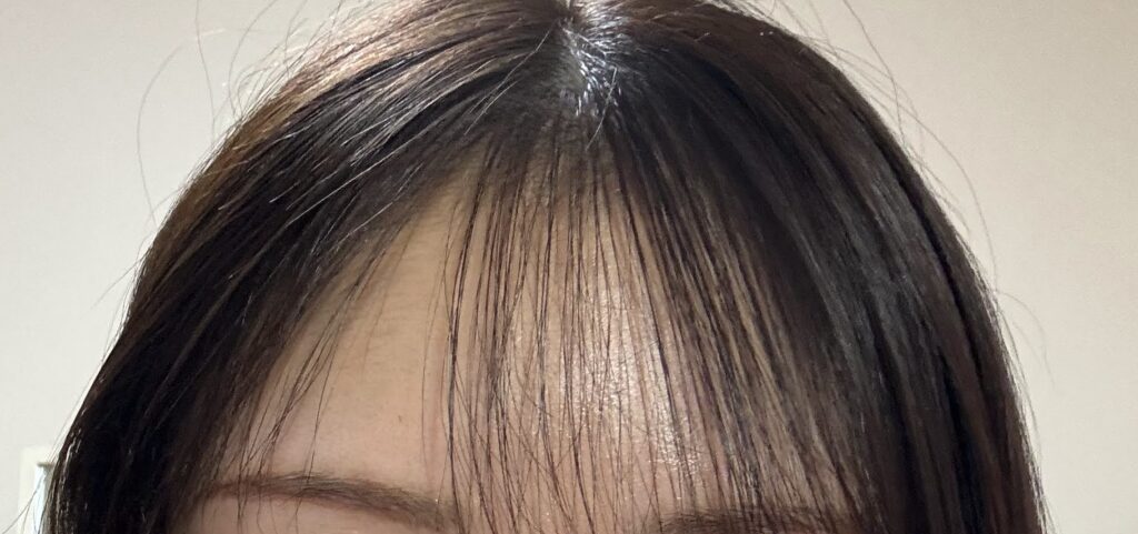 植毛から10か月後