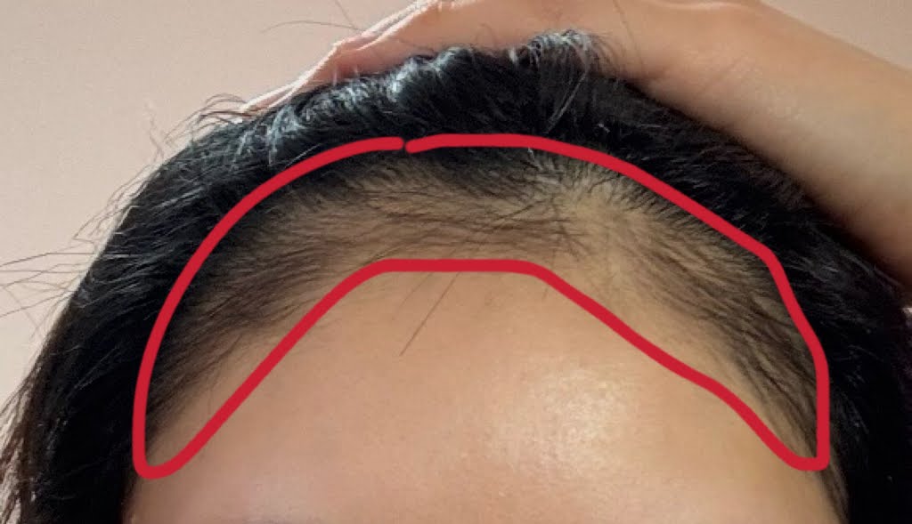 ミノキシジルで濃くなった産毛