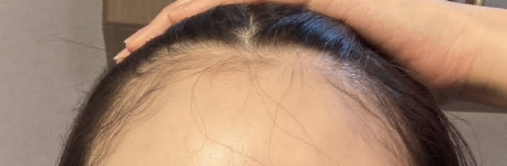 ミノキシジル使用前