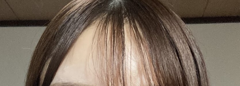 植毛前　チリチリ　女性　ヘアライン