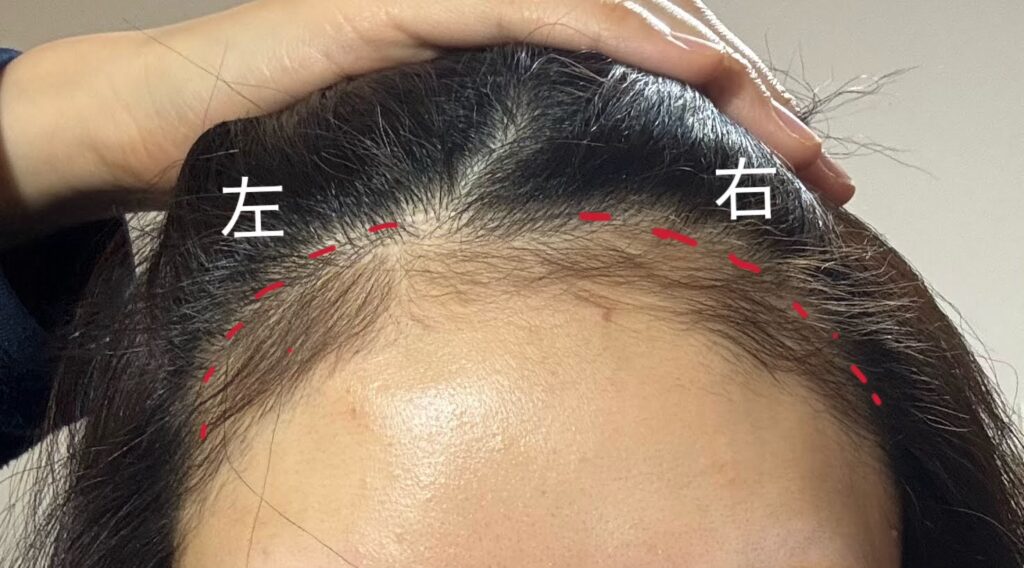 ヘアライン　女性　デザイン　植毛