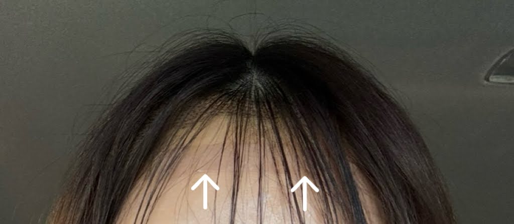 女性　ヘアライン植毛　定着率　上げる