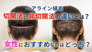 【ヘアライン植毛】切開法と非切開法の違いとは？女性におすすめなのはどっち？