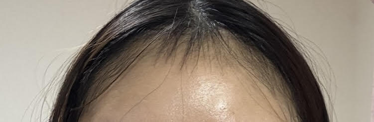 ヘアライン 植毛 女性 前髪 ショックロス