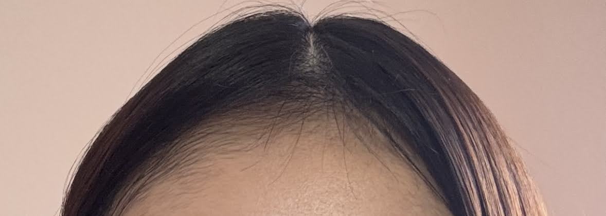 ヘアライン 植毛 女性 前髪 ショックロス 3ヶ月