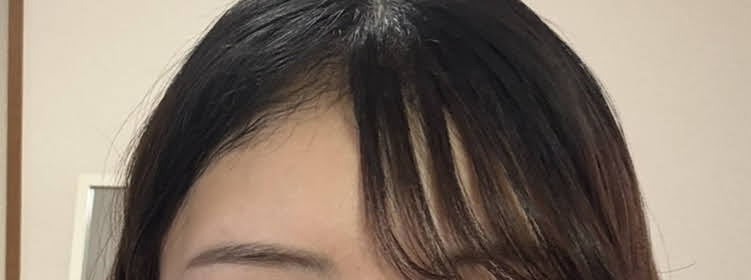 前髪 エクステ ダウンタイム 植毛 ヘアライン